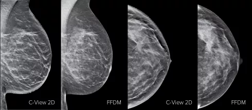 C-View 2D vs FFDM breast x-ray images