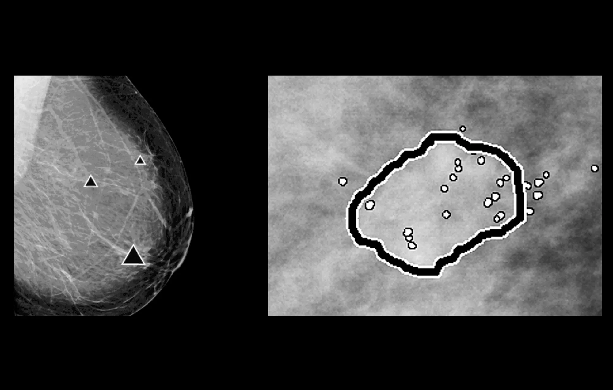 Digital mammography with peer emphasize marks