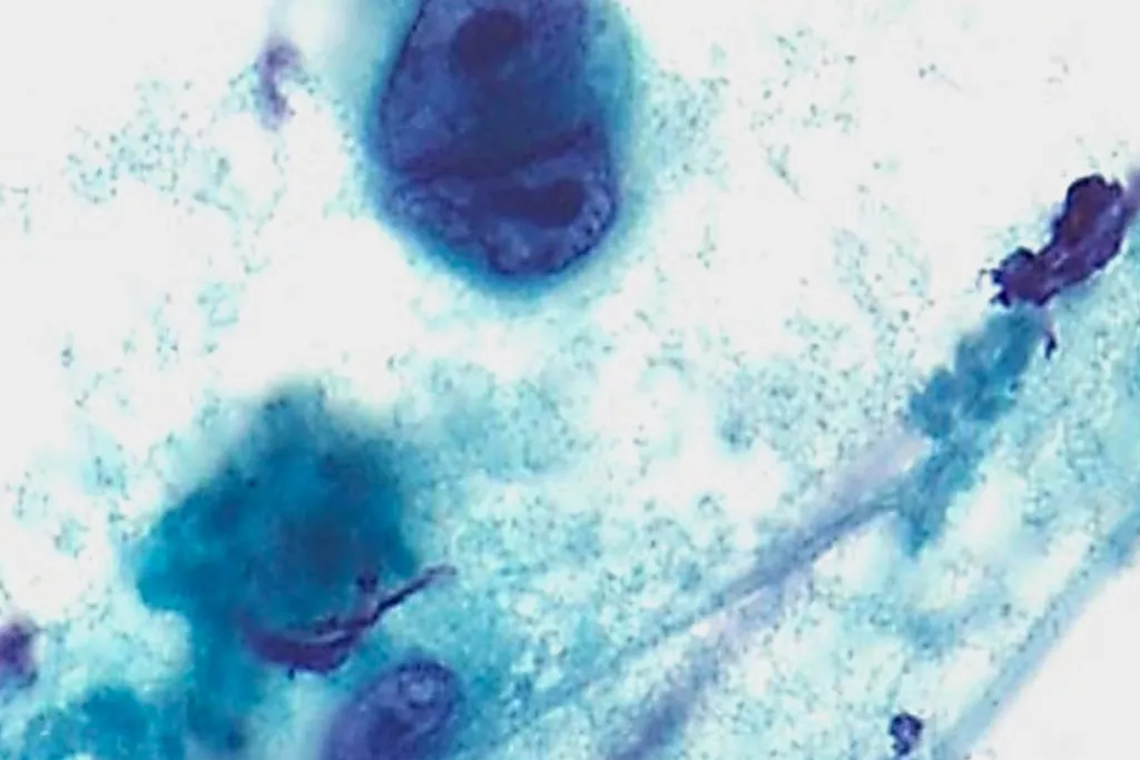 Hodgkins Lymphoma, FNA neck, Papanicolaou stain